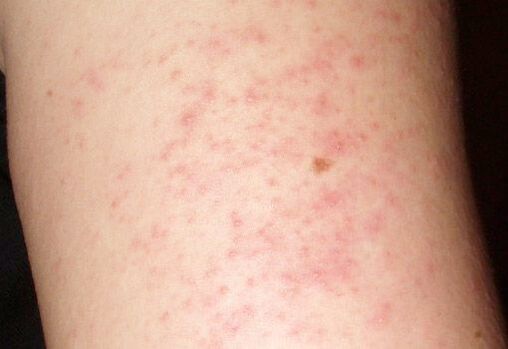 Itchy skin rash - a symptom of the presence of worms in the liver