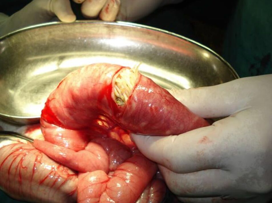 Roundworms in the human intestine